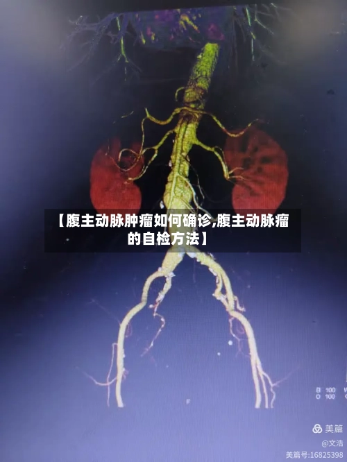 【腹主动脉肿瘤如何确诊,腹主动脉瘤的自检方法】-第2张图片